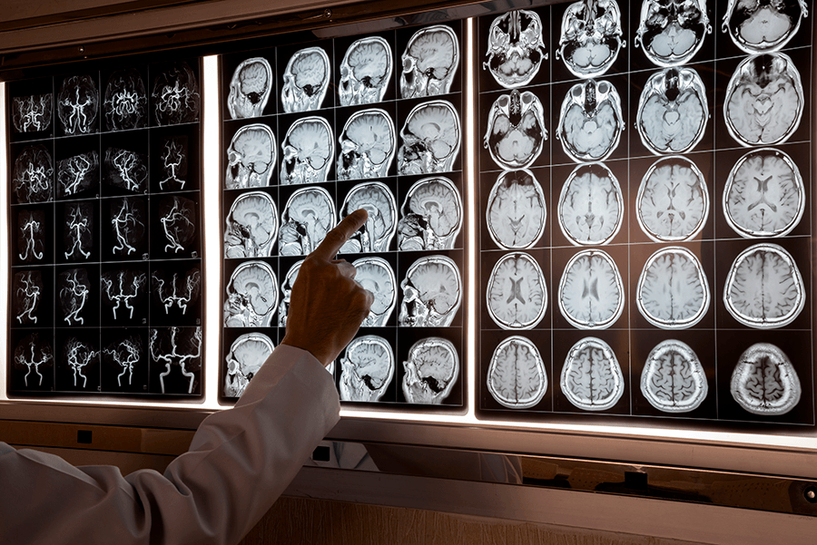 A doctor reviews brain scans on a light box.